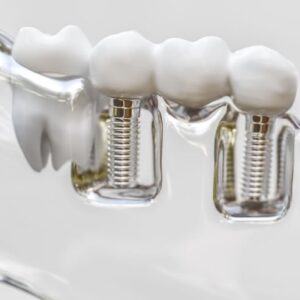 ایمپلنت دندان